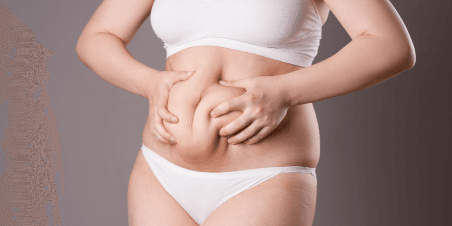 Risultato naturale Intervento di Addominoplastica