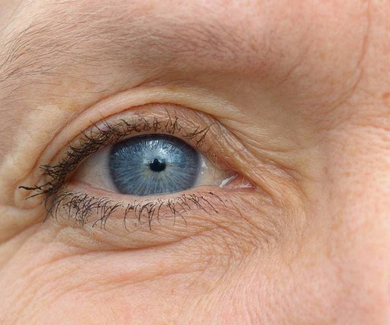 Upper and lower blepharoplasty: Eyelid surgery
