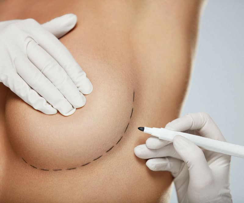 Breast Augmentation: Breast Enlargement Procedure