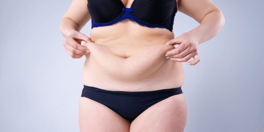 Natural Result Post-Obesity Surgery